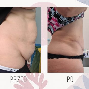 abdominoplastyka efekt - OT CO