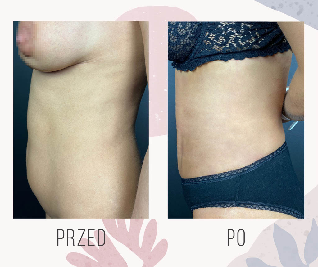 abdominoplastyka przed po - OT CO