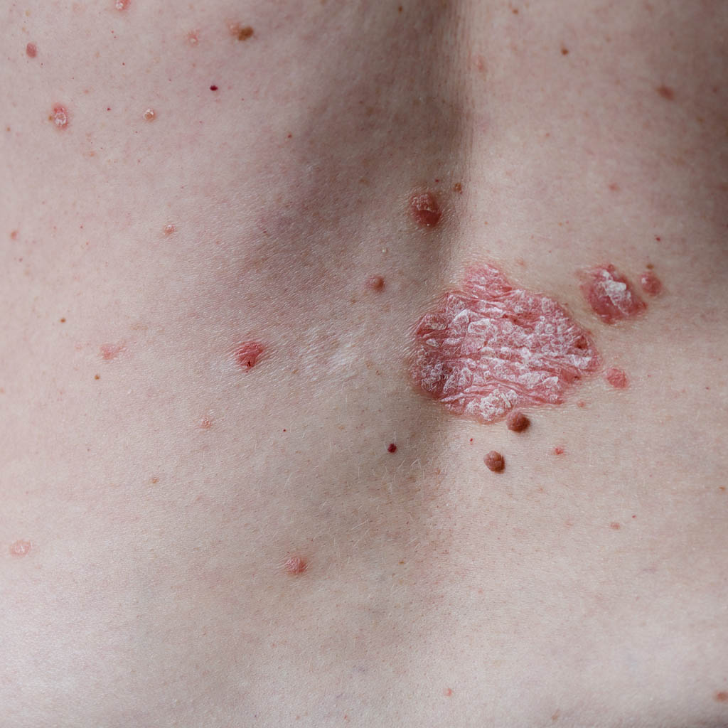 badania kliniczne w azs