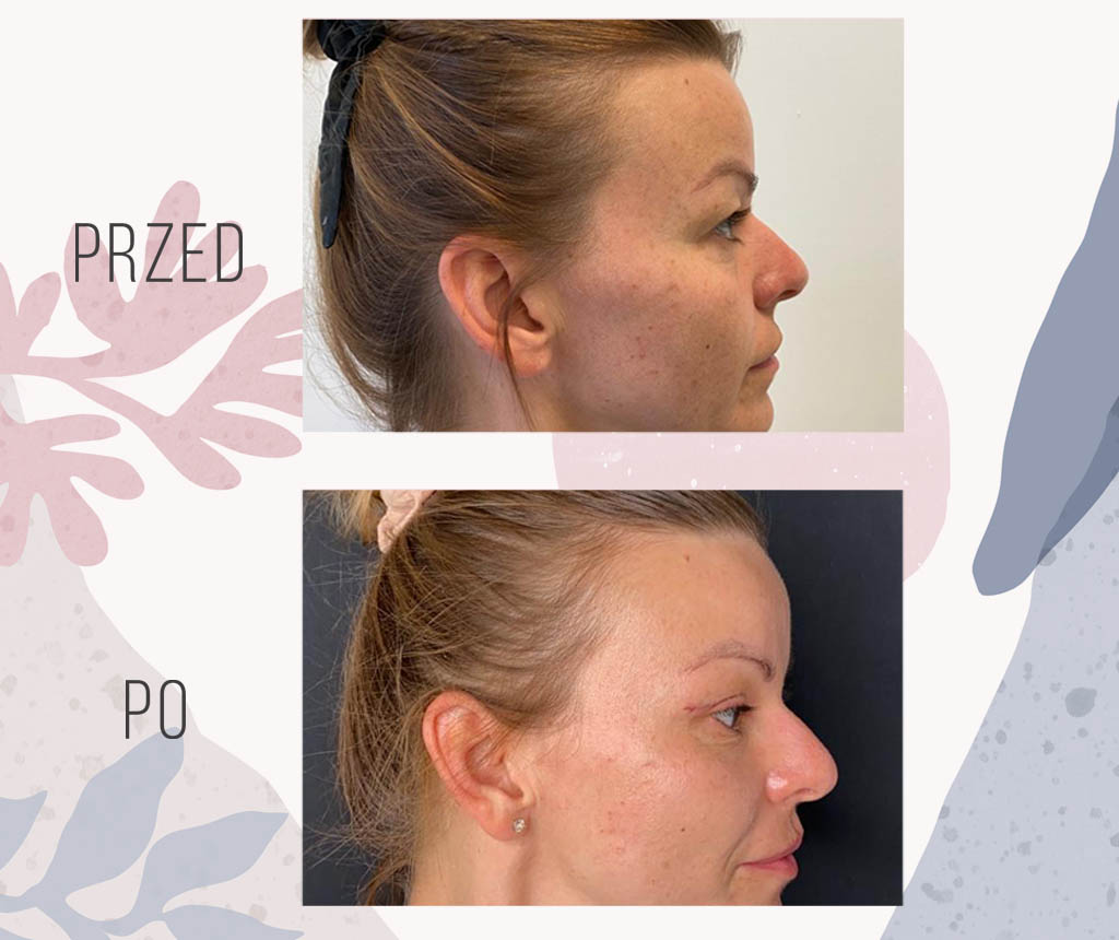 blefaroplastyka 1 - OT CO