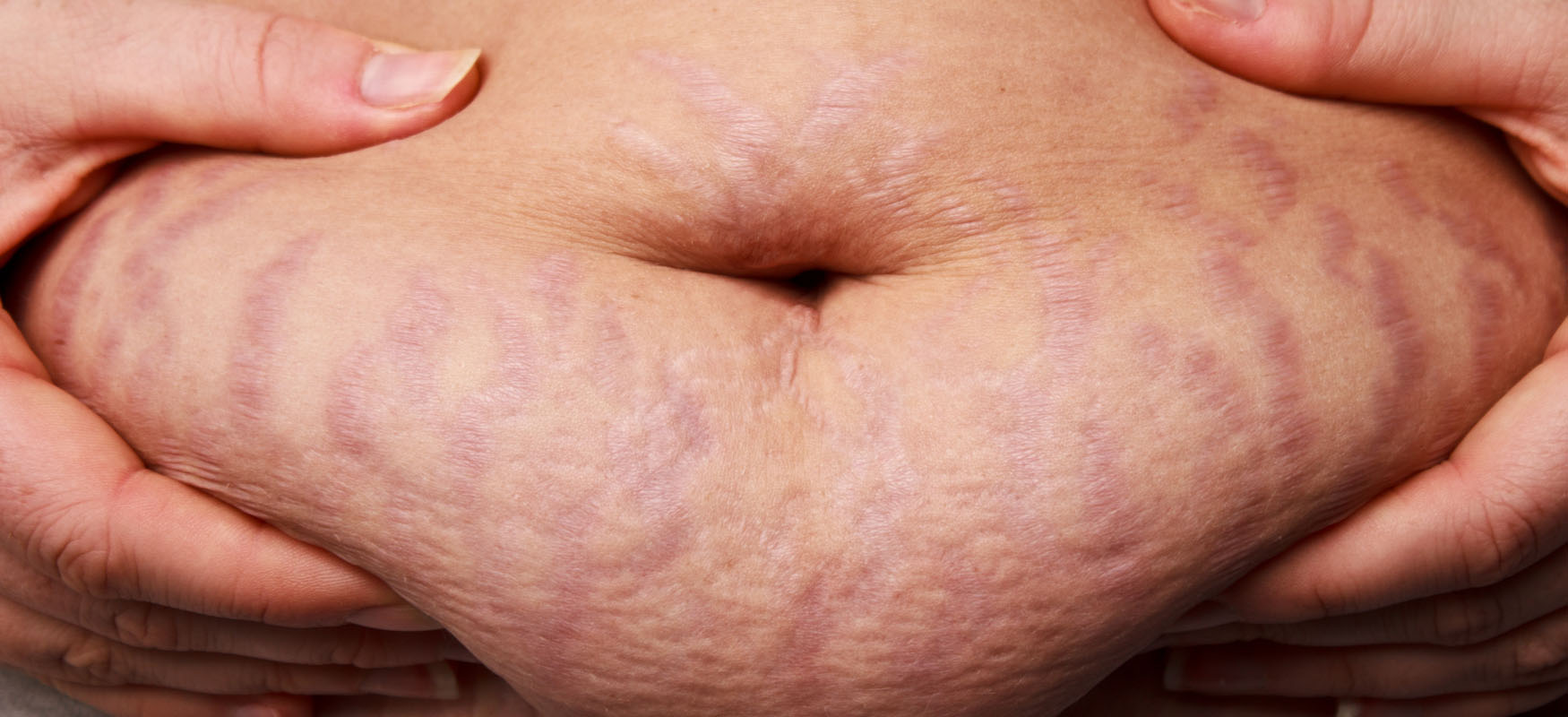 Brzuch po ciąży - pakiet zabiegów