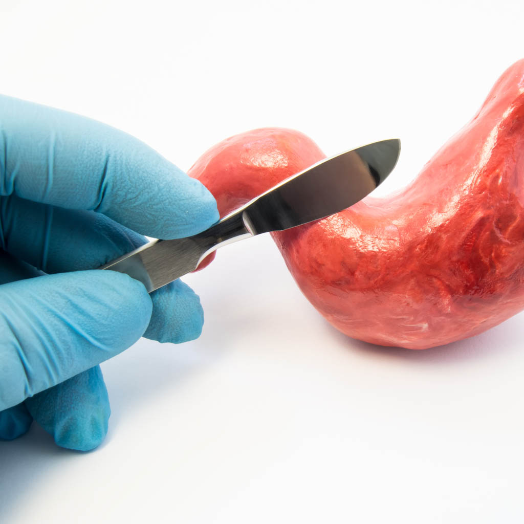 chirurgiczne zmniejszenie żołądka