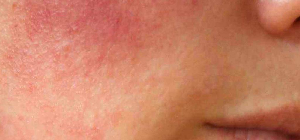 czerwone policzki czerwone policzki