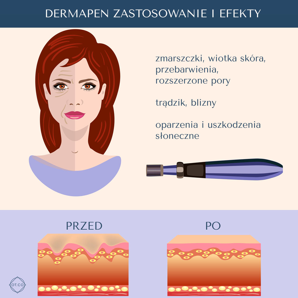 dermapen zastosowanie i efekty dermapen zastosowanie i efekty