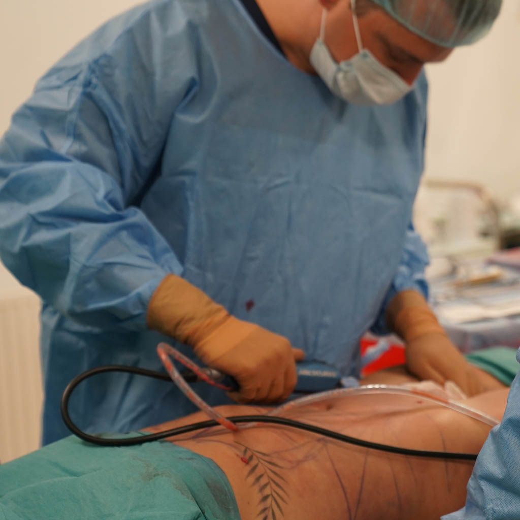 dr piotr turkowski podczas liposukcji - OT CO