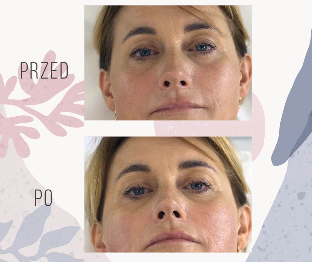 efekt zabiegu hifu na twarz - OT CO