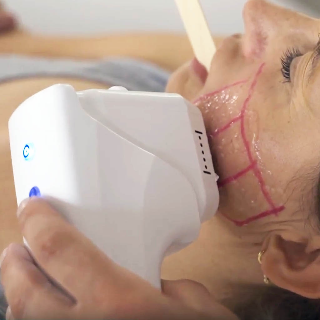 hifu na twarz|modelowanie twarzy zabieg hifu|maxresdefault|efekt zabiegu hifu na twarz|hifu na drugi podbrodek|hifu