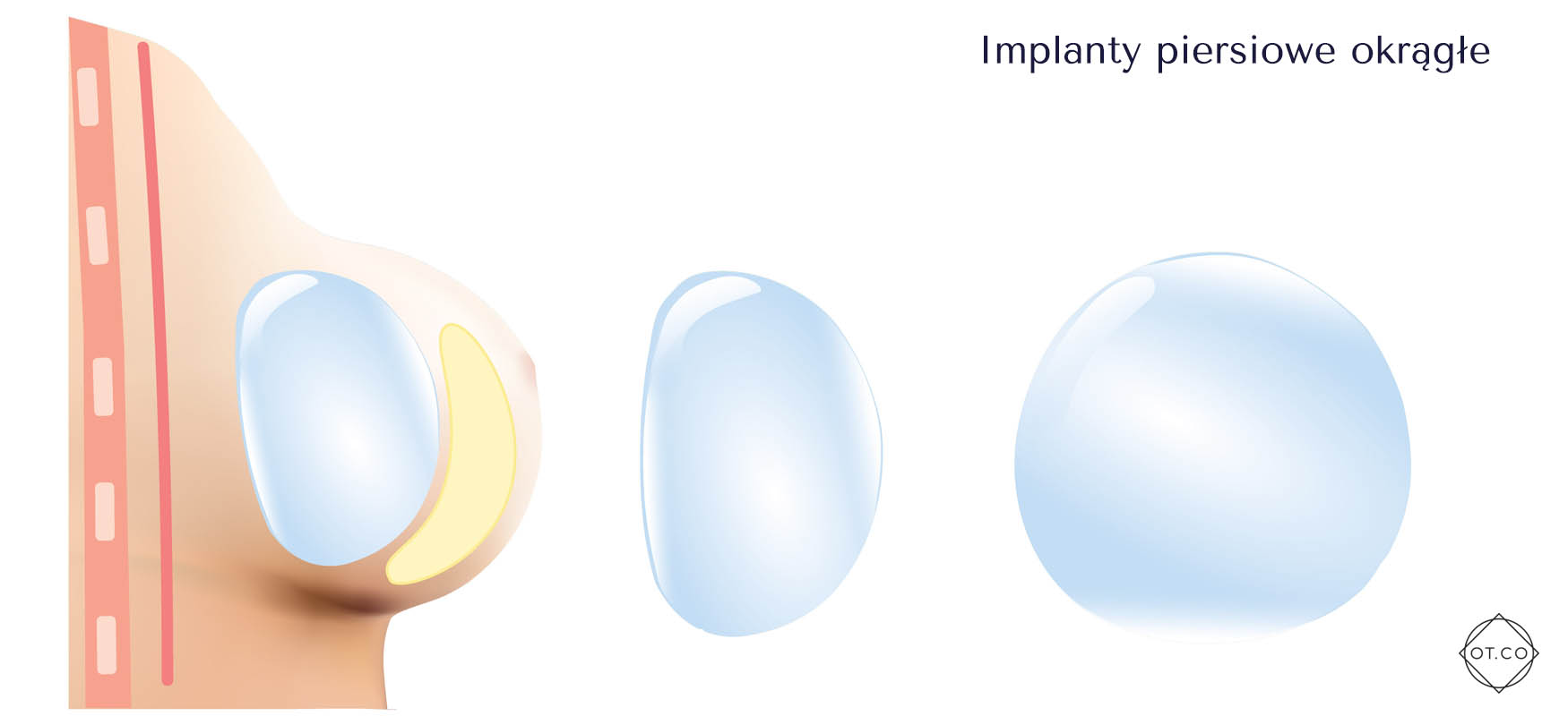 implanty piersiowe okragle implanty piersiowe okragle