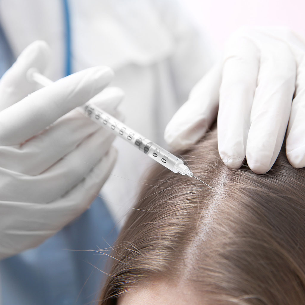 karboksyterapia co2 na wypadanie wlosow|maxresdefault