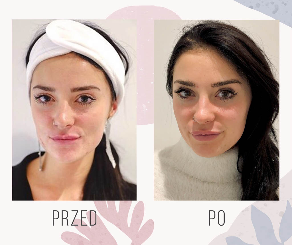 kwas hialuronowy na usta efekt kwas hialuronowy na usta efekt