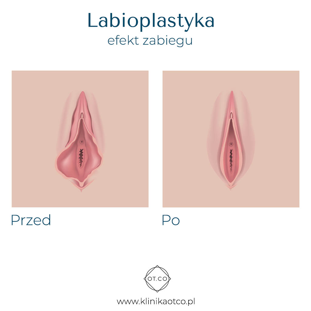 labioplastyka efekt - OT CO