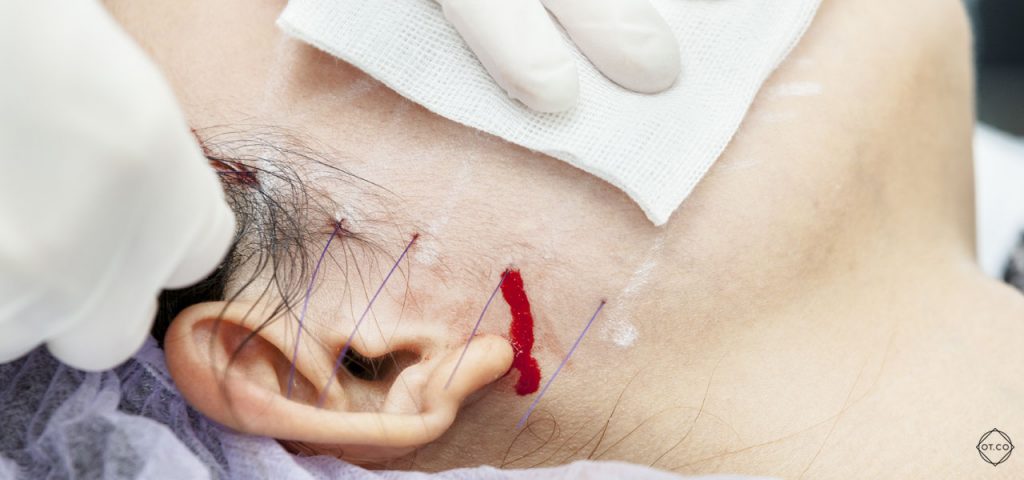 liftingujace nici pdo liftingujace nici pdo