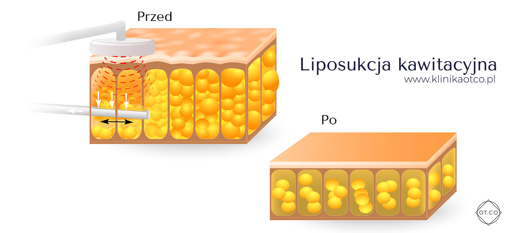 liposukcja kawitacyjna zasada działania liposukcja kawitacyjna zasada działania