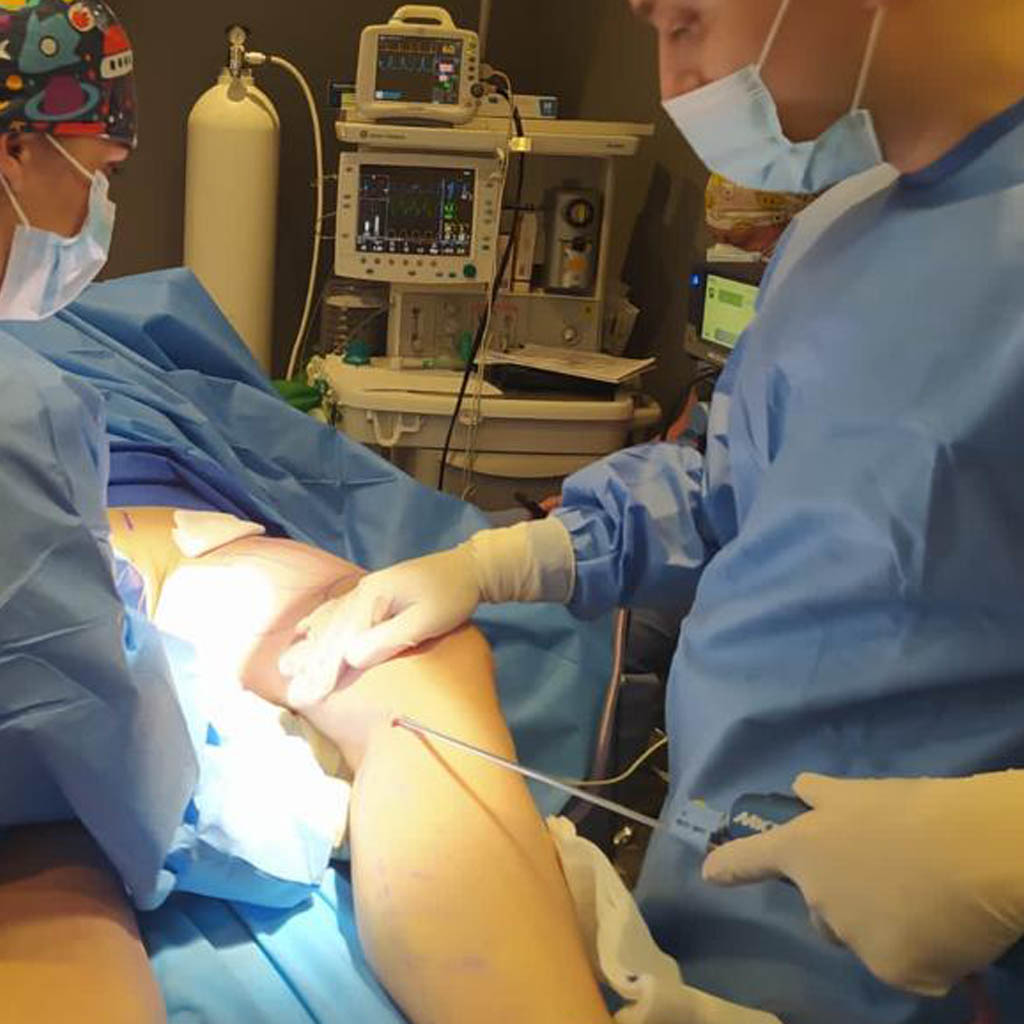 liposukcja nog 1 - OT CO