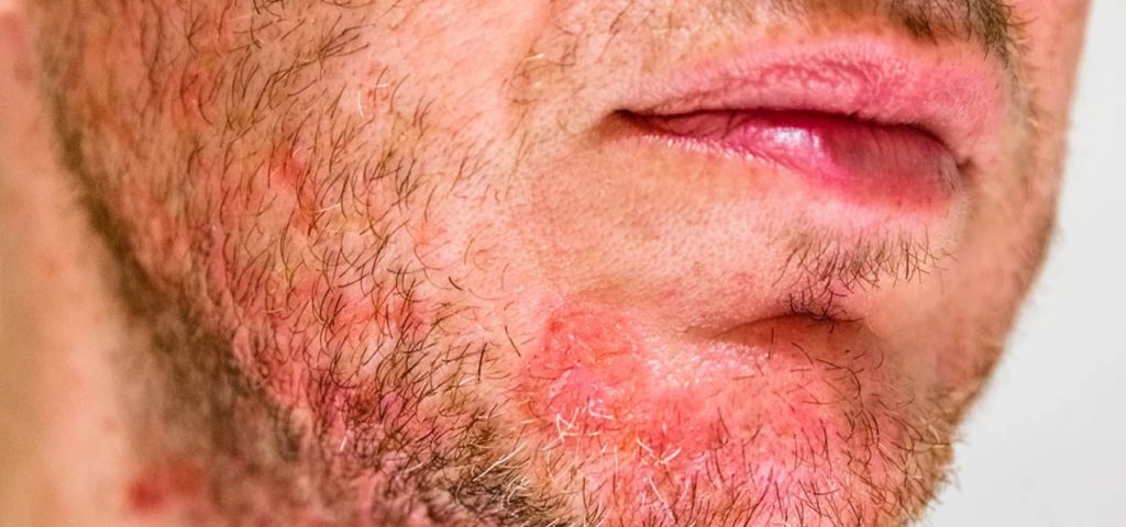 Łojotokowe zapalenie skóry twarzy Łojotokowe zapalenie skóry twarzy