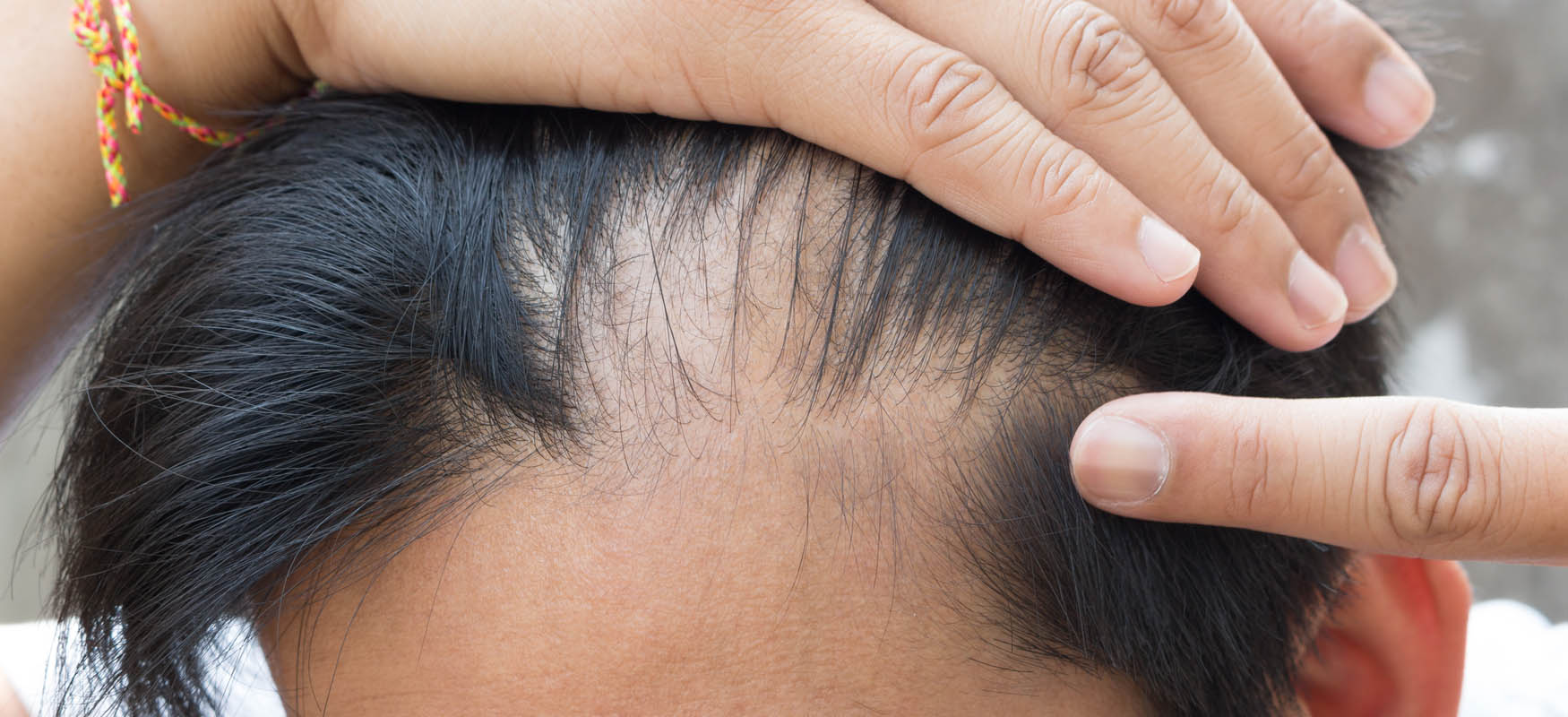 łysienie bliznowaciejące łysienie bliznowaciejące