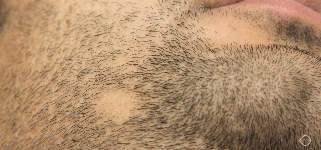 lysienie plackowate na brodzie lysienie plackowate na brodzie