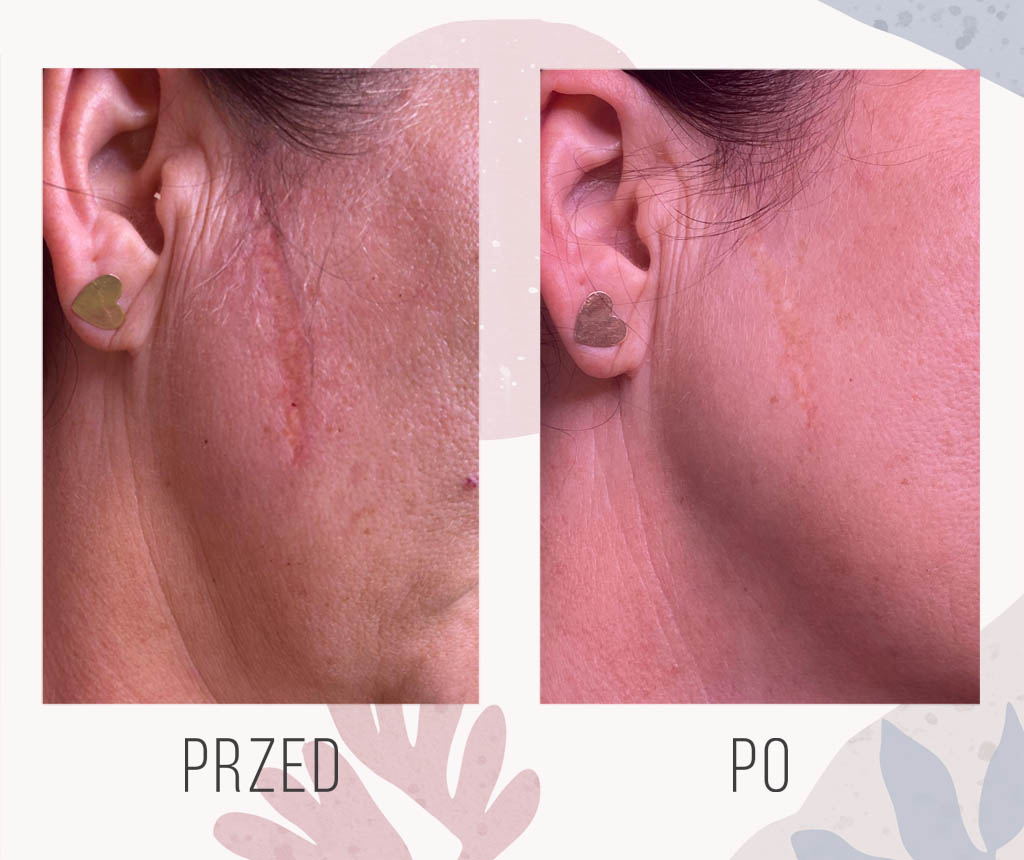 mikropunktura blizny na twarzy - OT CO