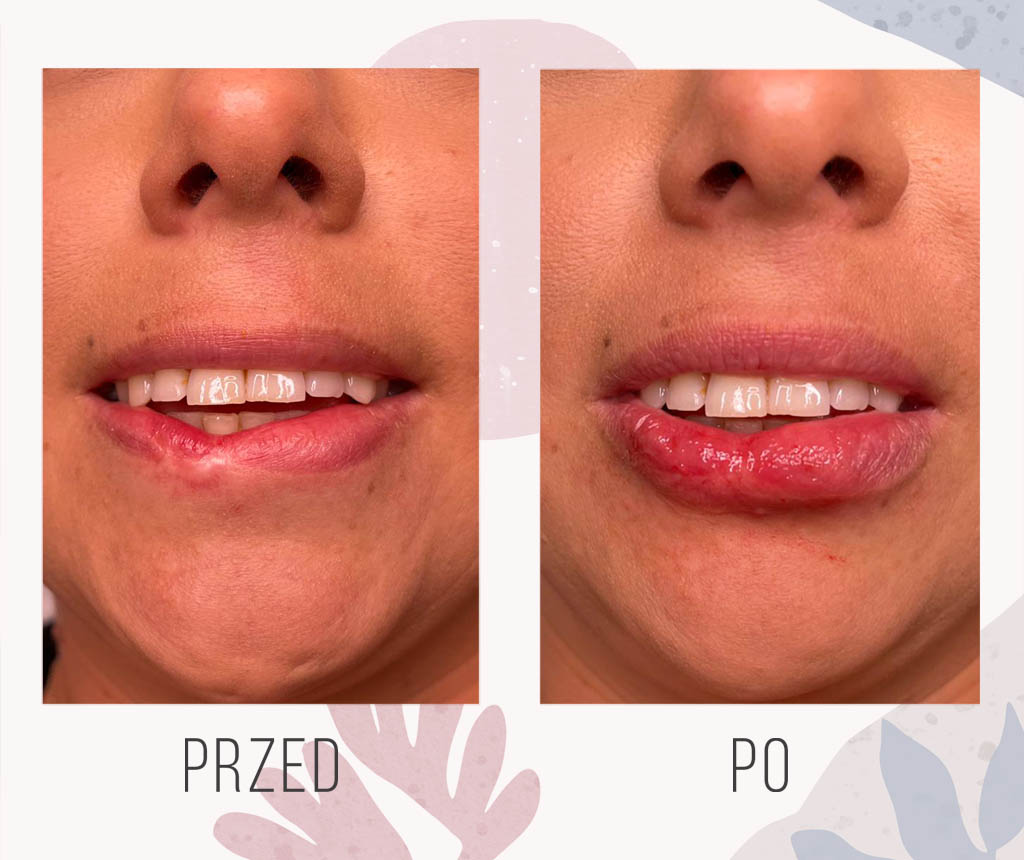 mikropunktura blizny na wardze - OT CO