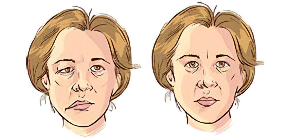 Objawy porażenia nerwu twarzowego