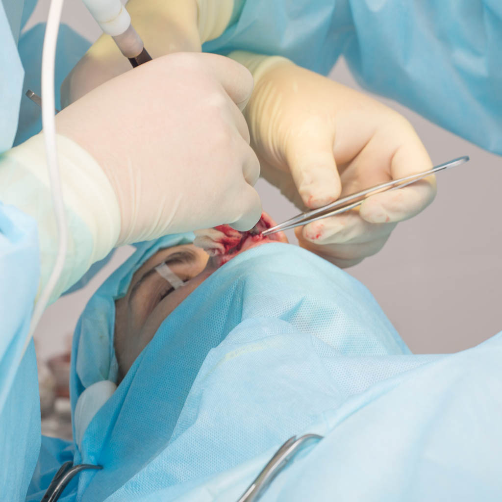 operacja nosa piezo - OT CO