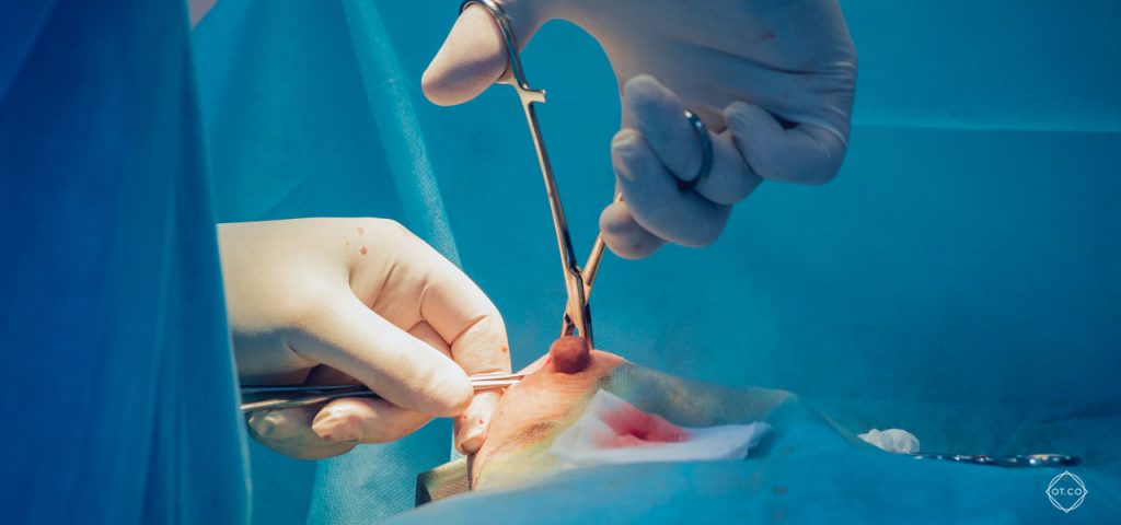 operacja zmniejszenia piersi