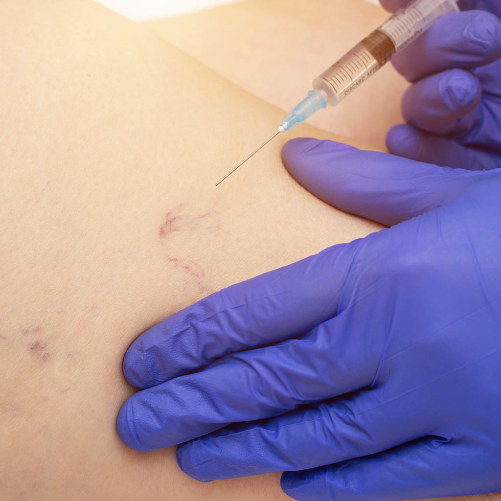 skleroterapia warszawa