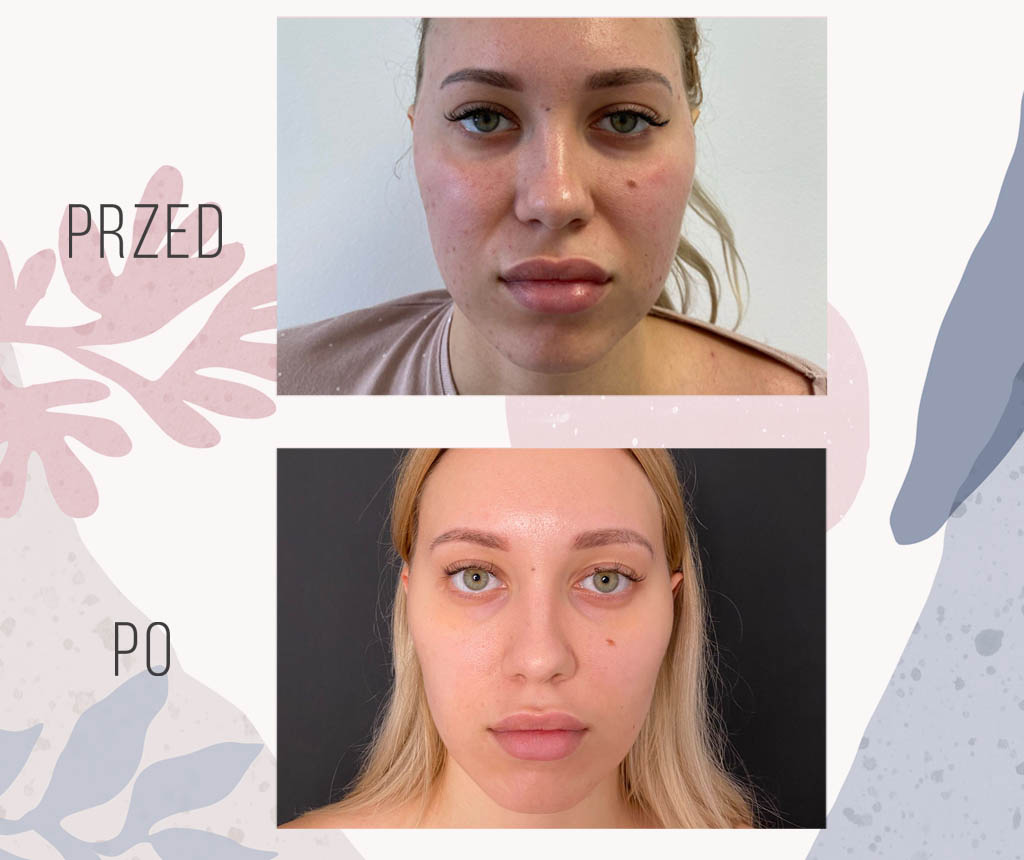 usuniecie poduszek bichata u kobiety efekt - OT CO
