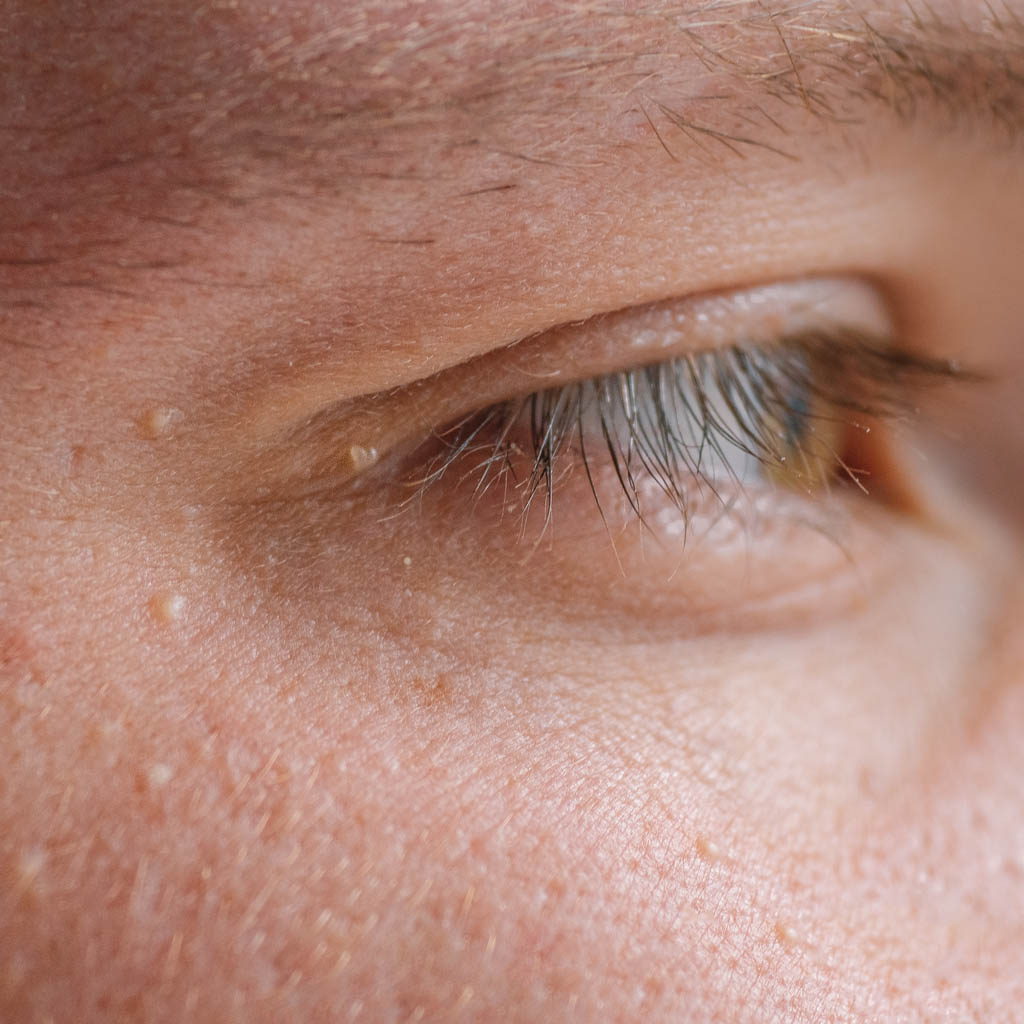 usuwanie brodawczaków z powieki