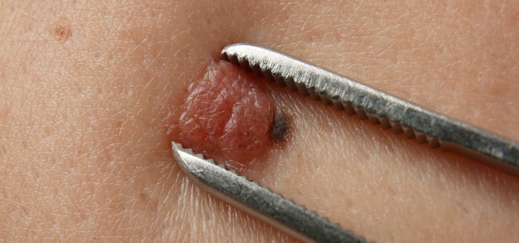 usuwanie czerniaka usuwanie czerniaka