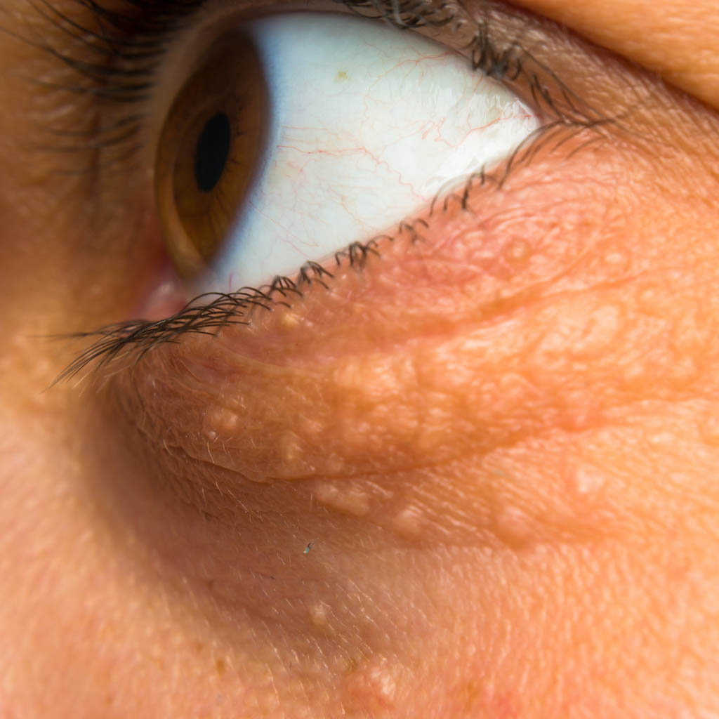 usuwanie kępek żółtych|zdrowe oczy