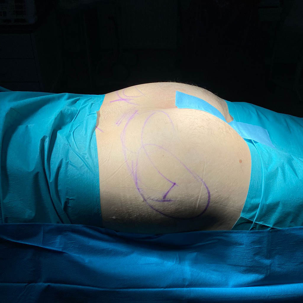 zabieg modelowania posladkow tluszczem - OT CO