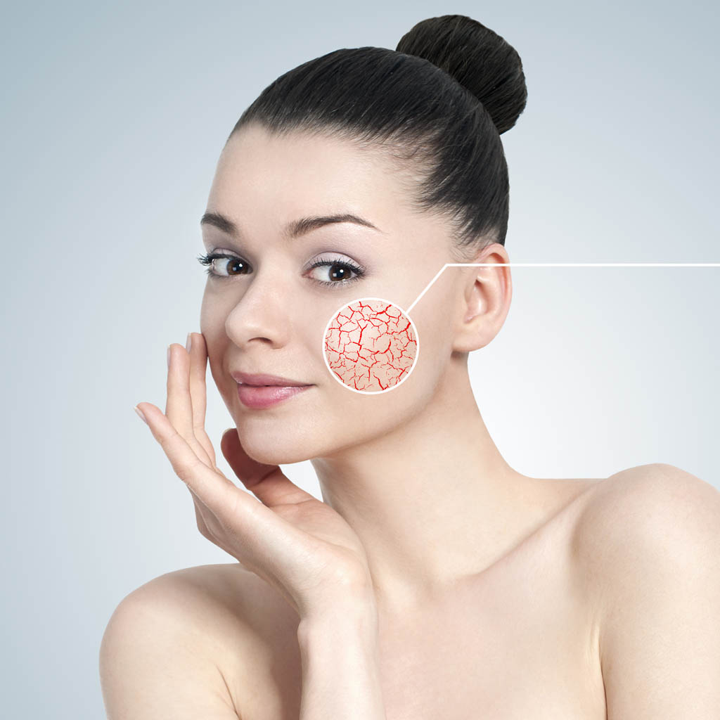 zabieg na cerę naczynkową