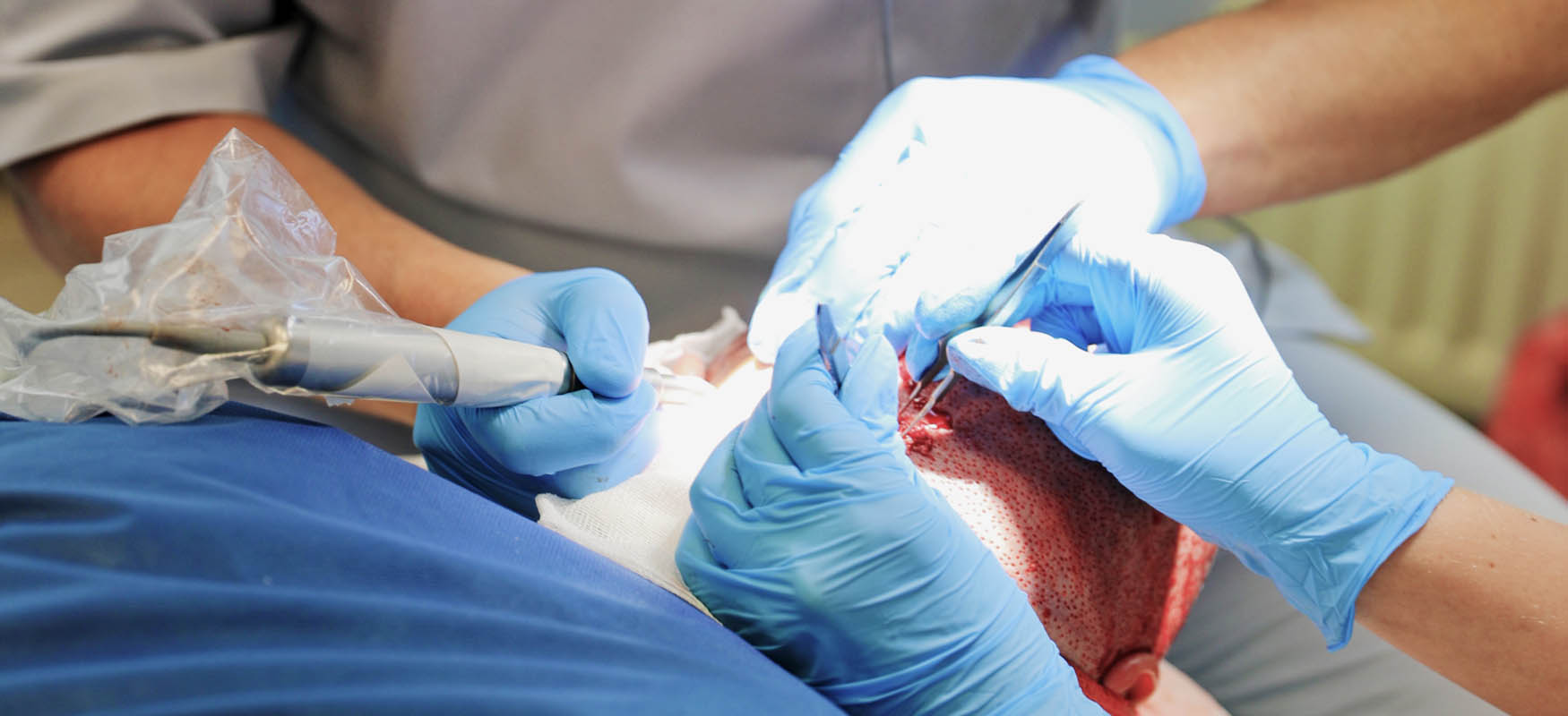 dr Piotr Turkowski podczas zabiegu przeszczepu włosów